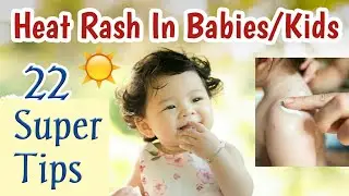 How To Treat Heat Rash In Kids | Home Remedies To Beat Prickly Heat
