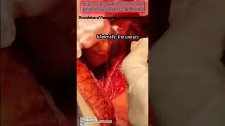 Bounderies of Para-aortic lymphadenectomy -Radical surgery of ovaian cancer part 1-