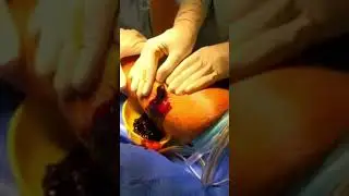 Evacuation of Heamatoma