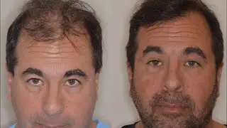 Transformative Hair Transplant Using Beard and Chest Hair | Anthony Bared, MD, FACS Miami, FL