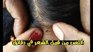 علاج القمل وحشرات الرأس بـ ٩ وصفات سيختفي للأبد بدون مركبات كيميائية تضر فروة الرأس