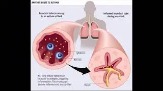 mesothelioma benign