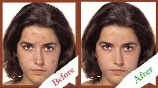 Photoshop İle Sivilceli Yüz Temizleme | Altınoluk Myo