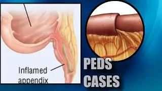 Cases - G.I. - Concurrent Intussusception and Appendicitis