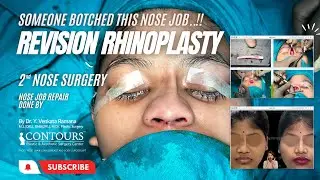 REVISION RHINOPLASTY | BOTCHED NOSE JOB REPAIR | 2nd NOSE SURGERY | CONTOURS PLASTIC SURGERY