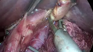 Gastrectomia Totale Laparoscopica con Linfoadenectomia D2 per Adenocarcinoma Gastrico Avanzato