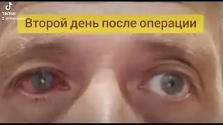 #Shorts Отслоение сетчатки глаза. Второй день после операции.Начинаю реабилитацию. #Acuklinika