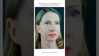 Спустя годы результат омоложения только улучшается 👌Елена прислала свои фото, 2 года после операции🔥