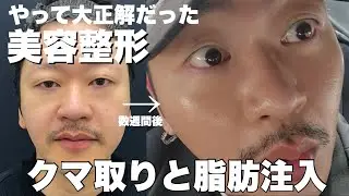 【美容整形】クマ取りして1ヶ月密着したら顔面人生変わった【クマ取り・脂肪注入・ダウンタイム】