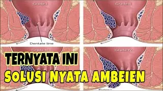 Ternyata Ini, Solusi Nyata Untuk Mengatasi Ambeien atau Wasir Menahun