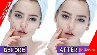 How To Get Rid Of Acne With One Knock (Photo Edit)