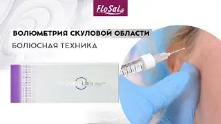 Волюметрия скуловой области препаратом Revofil Ultra