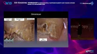 XIII Workshop - V. Piccolo - Update dermoscopia malattie infettiva