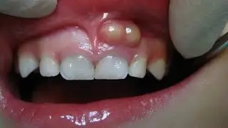 दांतों में पस , INFECTION- DENTAL ABSCESS - ITS TYPES -CAUSES AND TREATMENT- DR. Rajni Bala- HINDI