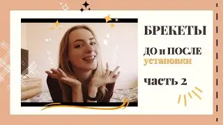 Установила БРЕКЕТЫ, зубы ДО/ПОСЛЕ установки