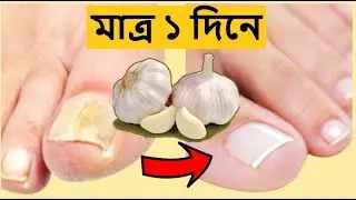 যন্ত্রণাদায়ক নখকুনি পাঁচ প্রতিকার। Five Remedies for Painful Nails