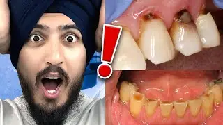 What Are Those BROWN SPOTS On Your Teeth? (And How To Get Rid of Them)