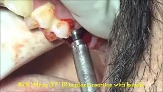 Root canal reinfection molar extraction & replacement with BCS implants