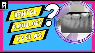 Dental Radiology Case3| Radiographic Interpretation |DENTAL CASE DISCUSSION| Facial space infection