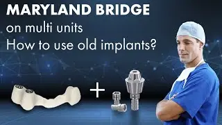 MARYLAND dental BRIDGE on multi units | How to use old dental implants | Digital impression