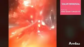 Valve Removal  | Dr. Hinze Using the aScope 5 Broncho HD