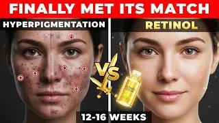 Retinol ERASES Dark Spots in 12 Weeks (The Science)