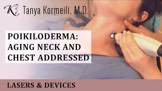 Poikiloderma: Aging Neck and Chest addressed!