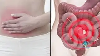 Koliti ulçeroz - mbroshendetin.al