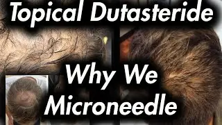 Topical Dutasteride & Microneedling: Why It Helps