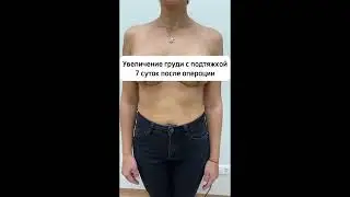 Увеличение груди с «якорной»подтяжкой (восстановления после родов🥰) в моём исполнении. 7 суток.