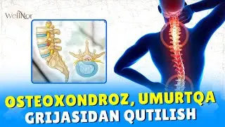 Mo'jiza! Osteoxondroz, Umurtqa grijasidan uy sharoitida xalos bo'lish