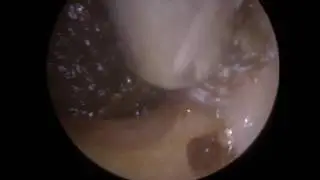 Endoscopic Microsuction of Deep Impacted Ear Wax inc. off Eardrum  - 