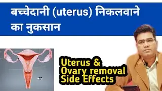 What are the Complications and Side Effects of Hysterectomy & Ovary Removal ( In Hindi)