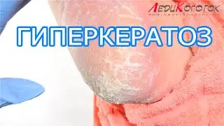 Педикюр! Гиперкератозная стопа с Трещинами пяток и Заломами стопы