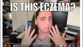 TSW - Topical Steroid Withdrawal & Eczema.