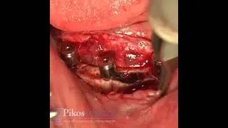 Pikos Transosseous Suture