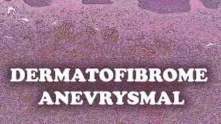 LE DERMATOFIBROME ANEVRYSMAL– PATHOLOGIE