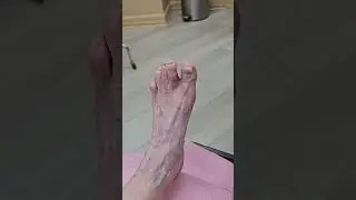 First Metatarsophalangeal (MTP) Joint Fusion | Bunion