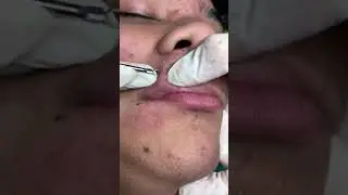 Dark Sebum Removal from the Face