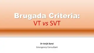 Brugada criteria:  How to differentiate VT from SVT