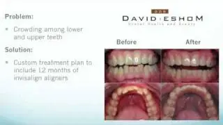 Invisalign San Diego, La Jolla