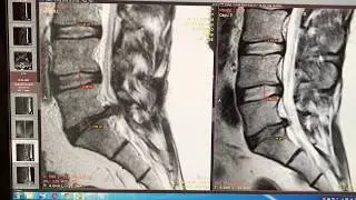 Лечение огромной Грыжи методом резорбции в медицинском центре Атлант