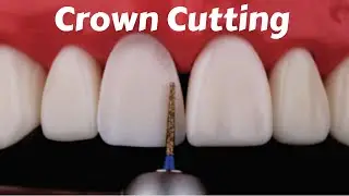Crown Tooth Preparation Cutting for Anterior Incisor PFM Zirconia Ceramic Emax - Prostho Lecture