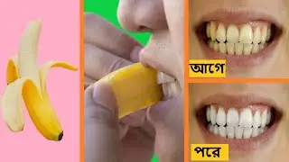 মাত্র ২ মিনিটে দাঁত সাদা করবে কলার খোসা। How to Whiten Your Teeth with Banana Peel In just 2 minutes