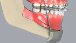 Class III Reverse Pull Headgear Appliance
