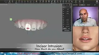 Clear Aligner Tip: Upper Incisor Intrusion