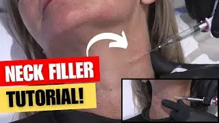 REMOVE NECK LINES WITH FILLER TUTORIAL
