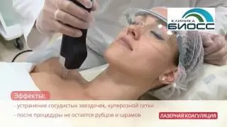 Удаление сосудистых звездочек. Лазерная коагуляция сосудов.