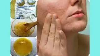 Угриден калган тактардан арылгыныз келсе бул масканы жасаныз!!! Супер арзан маска