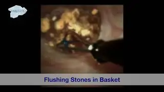 Flushing Stones into Basket